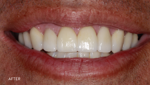 Smile Makeover - Case 1 - After image