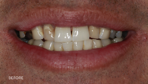 Smile Makeover - Case 1 - Before image
