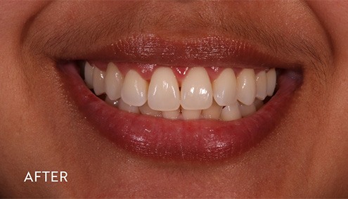 Smile Makeover - Case 14 - After image