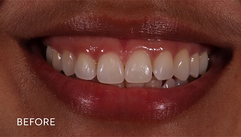 Smile Makeover - Case 14 - Before image