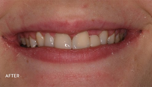 Smile Makeover - Case 15 - After image