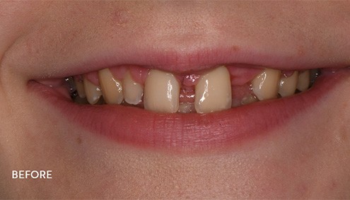 Smile Makeover - Case 15 - Before image