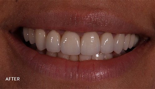 Smile Makeover - Case 16 - After image