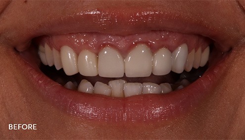 Smile Makeover - Case 16 - Before image