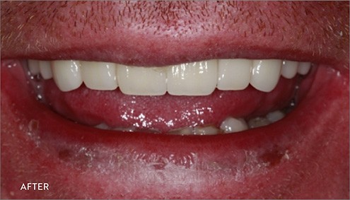 Smile Makeover - Case 17 - After image