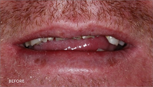 Smile Makeover - Case 17 - Before image