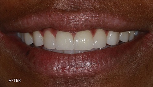 Smile Makeover - Case 2 - After image