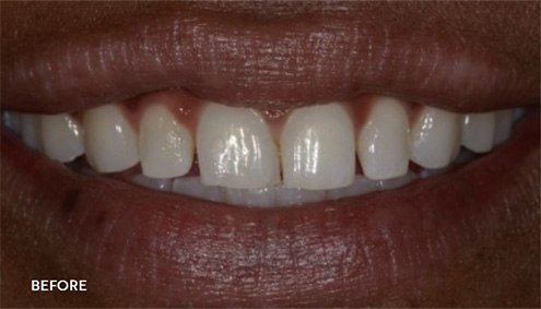 Smile Makeover - Case 2 - Before image