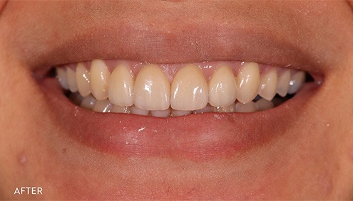 Smile Makeover - Case 3 - After image