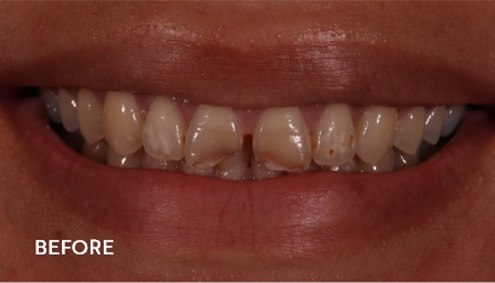 Smile Makeover - Case 3 - Before image