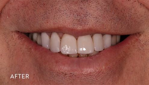 Smile Makeover - Case 4 - After image