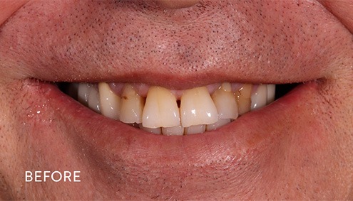 Smile Makeover - Case 4 - Before image