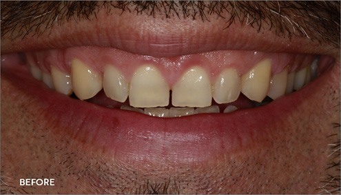 Smile Makeover - Case 5 - Before image