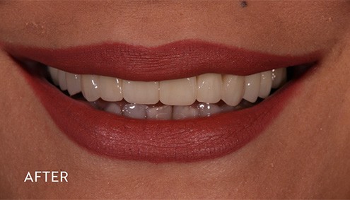Smile Makeover - Case 8 - After image