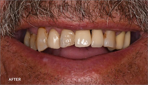 Smile Makeover - Case 9 - After image