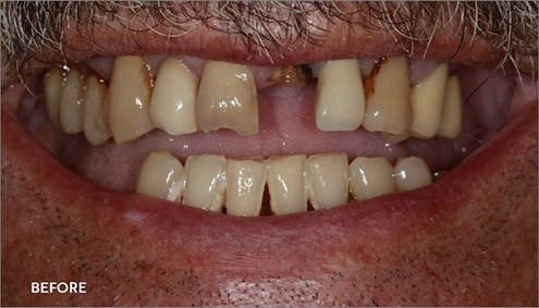 Smile Makeover - Case 9 - Before image
