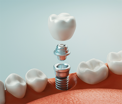 Illustrated dental crown on a dental implant