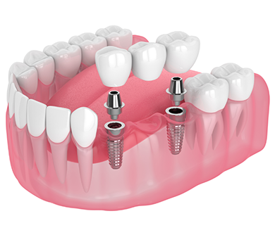 Illustrated dental bridge on two implants