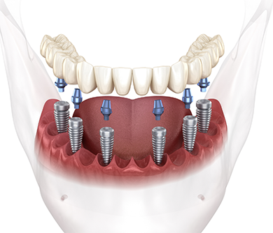 Illustrated denture on six implants