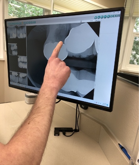 Pointing to images of teeth on computer monitor