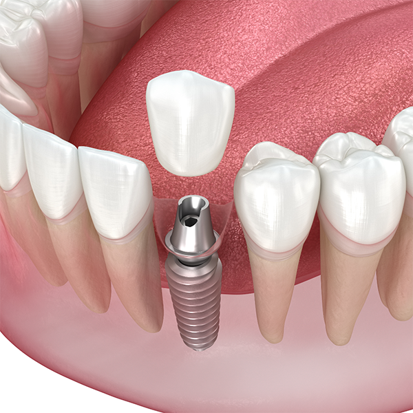 Illustration of a dental implant with a crown replacing a missing tooth