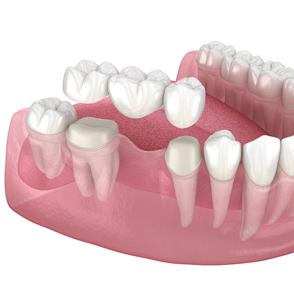 Illustration of a dental bridge replacing a missing tooth