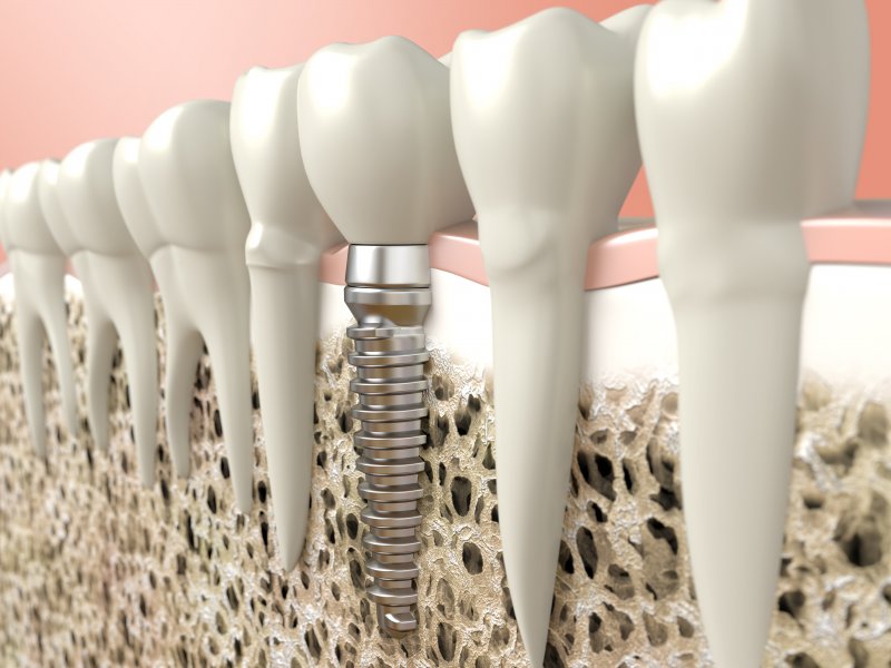 Dental implant illustration